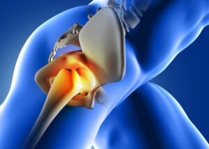 Артроз кульшових суглобів